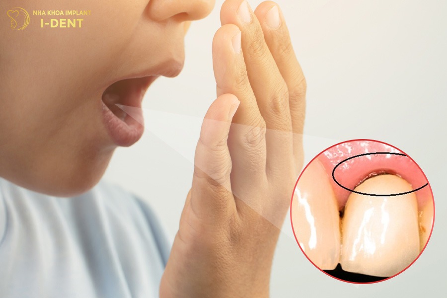 Răng sứ bị hở khiến thức ăn dễ giắt vào và gây hôi miệng nếu không được vệ sinh kỹ.