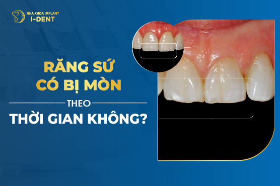 Răng Sứ Có Bị Mòn Theo Thời Gian Không?
