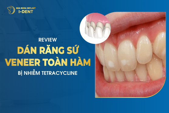 Review Dán Răng Sứ Veneer Toàn Hàm Bị Nhiễm Tetracycline