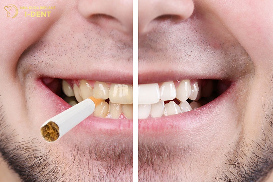 Hạn chế hút thuốc lá tránh ảnh hưởng đến màu răng