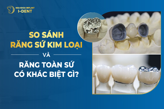 So Sánh Răng Sứ Kim Loại Và Răng Toàn Sứ Có Khác Biệt Gì?