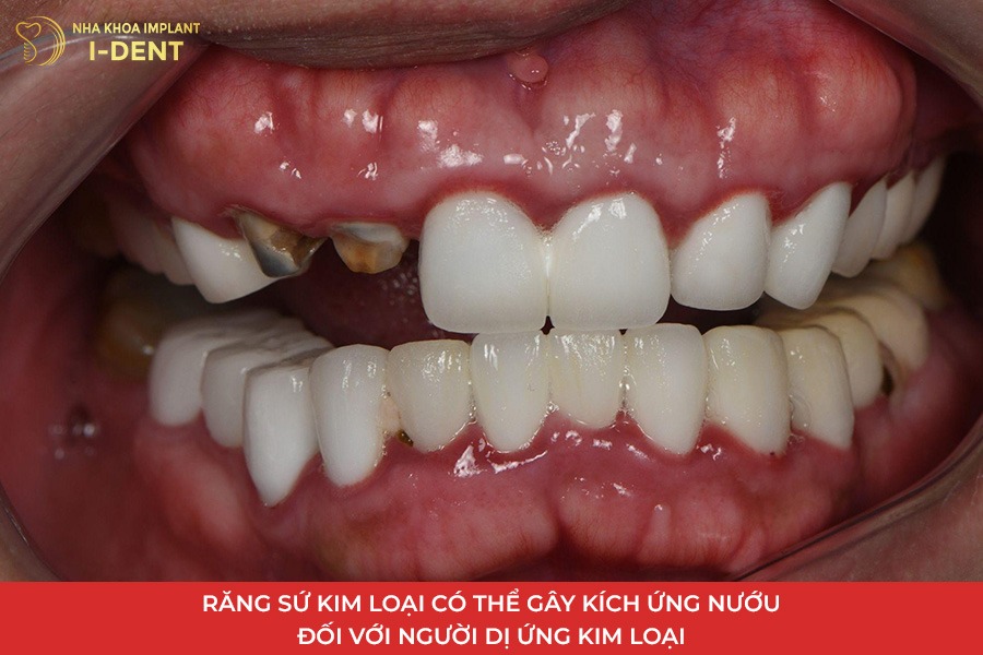 Răng sứ kim loại có thể gây kích ứng nướu. 