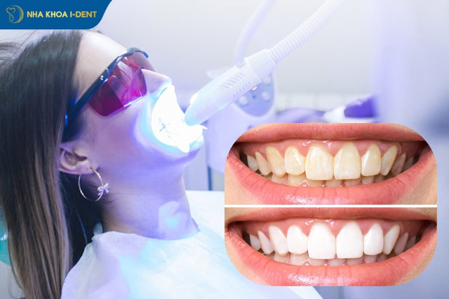 tẩy trắng răng là gì