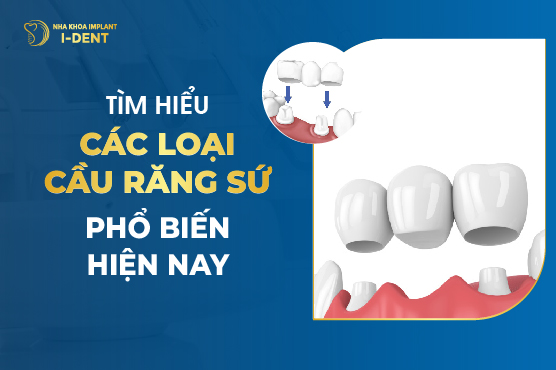Tìm Hiểu Các Loại Cầu Răng Sứ Phổ Biến Hiện Nay