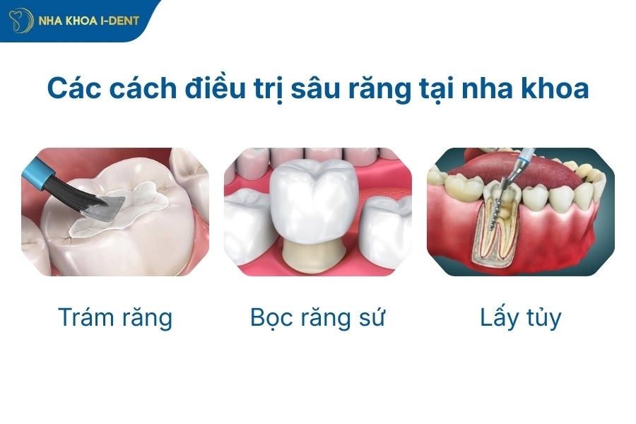 cách trị sâu răng