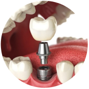 V2 Giai Phap Cho Nguoi Mat Rang 1 1