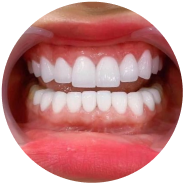 V2 Khac Phuc Khuyet Diem Cua Rang