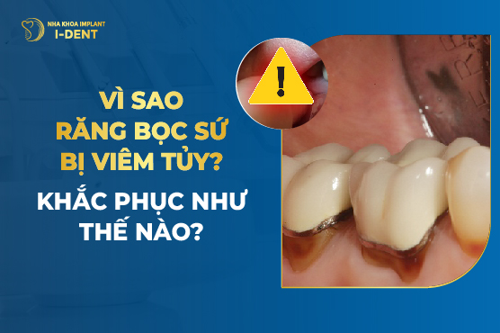 Vì Sao Răng Bọc Sứ Bị Viêm Tủy? Khắc Phục Như Thế Nào?