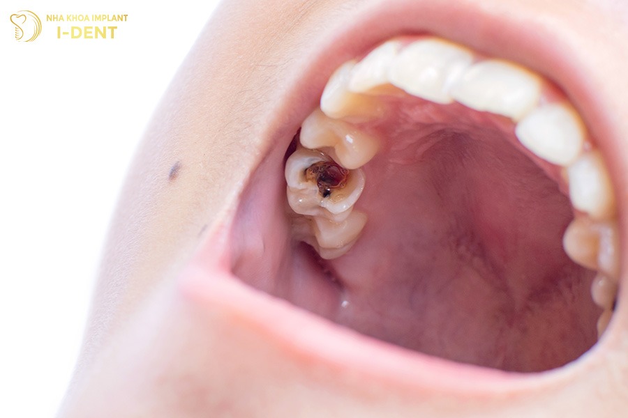 chữa viêm tủy răng