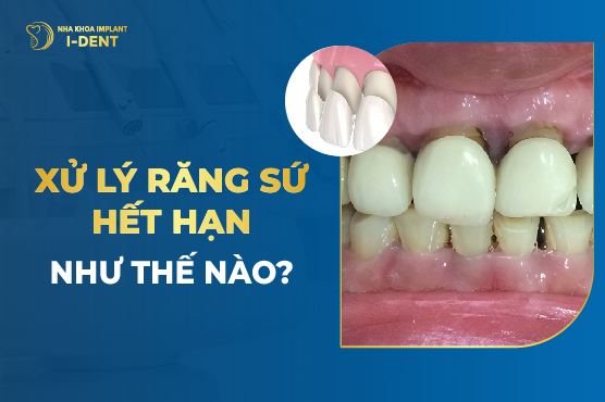 Xử Lý Răng Sứ Hết Hạn Như Thế Nào?