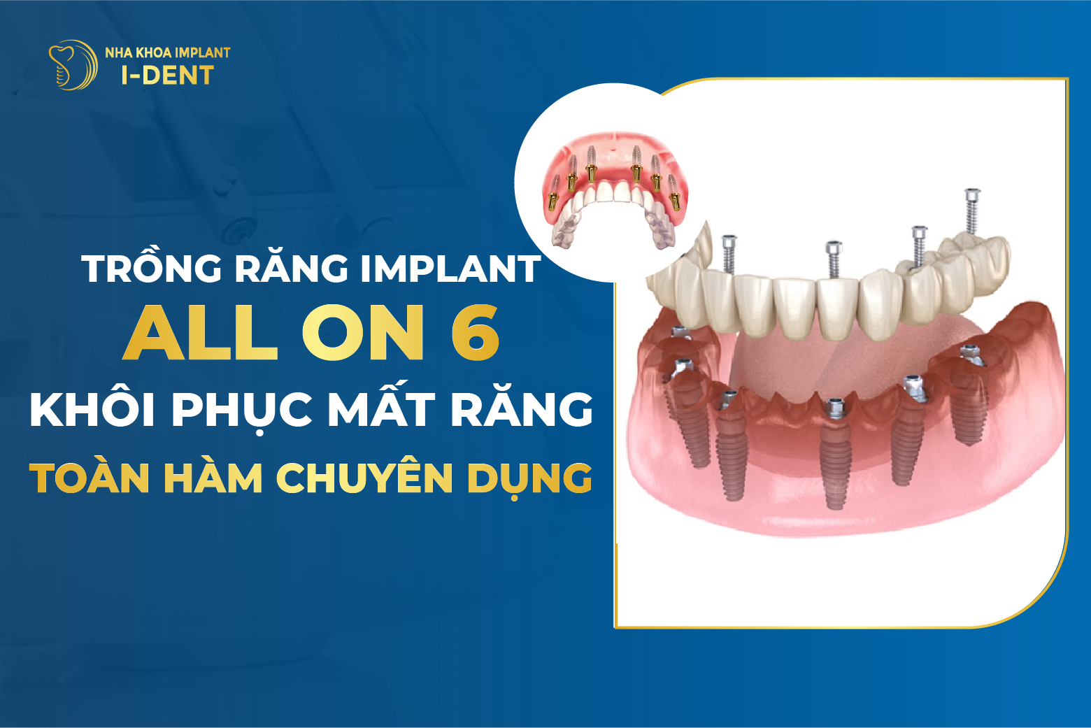 Trồng răng Implant All On 6: Quy trình và chi phí