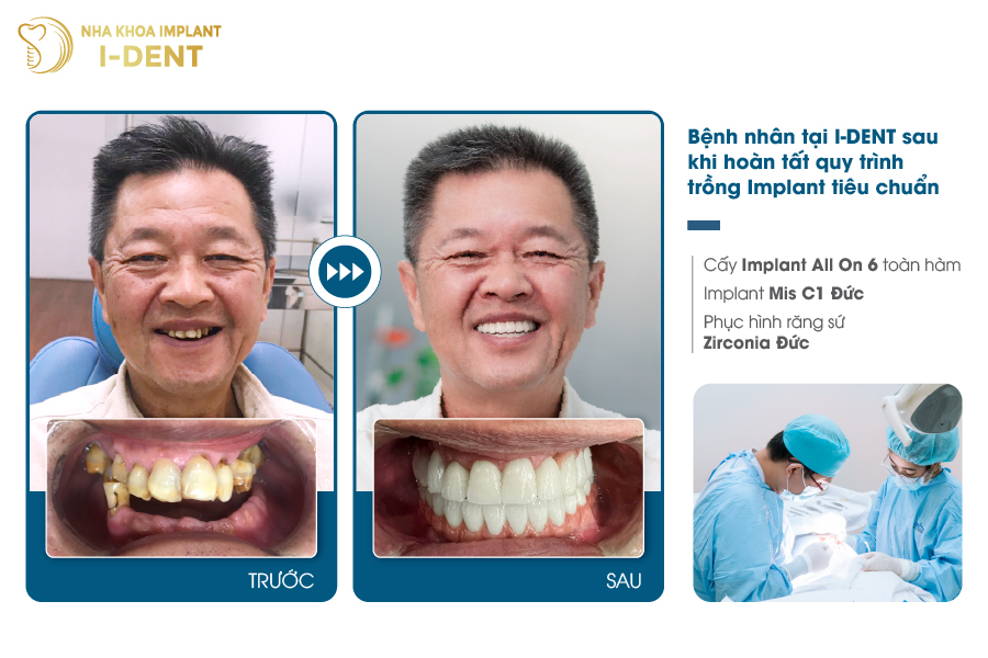 cấy ghép implant all on 6