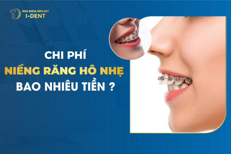 Chi Phí Niềng Răng Hô Nhẹ Bao Nhiêu Tiền?