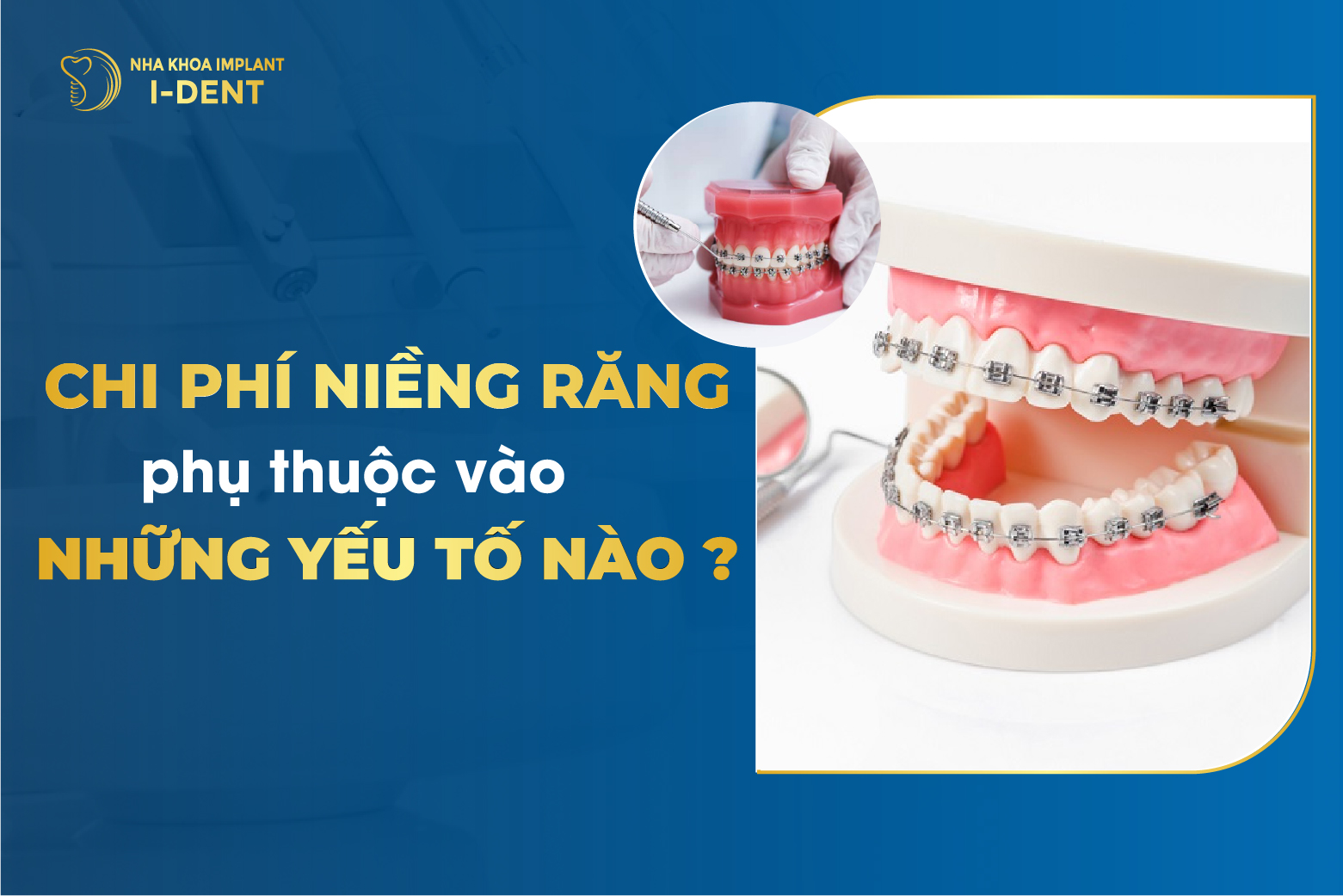[Tháng 2/2026] Niềng Răng Giá Bao Nhiêu? Chi Phí Mới Nhất