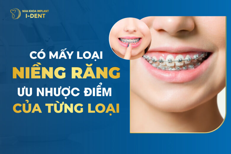 Niềng Răng Có Bao Nhiêu Loại? Ưu Và Nhược Điểm Từng Loại
