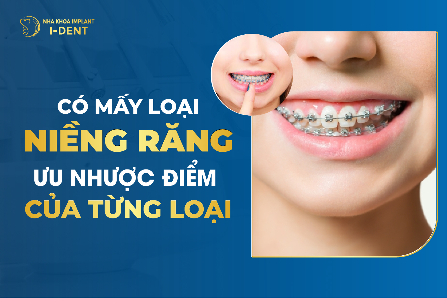 Niềng Răng Có Bao Nhiêu Loại? Ưu Và Nhược Điểm Từng Loại