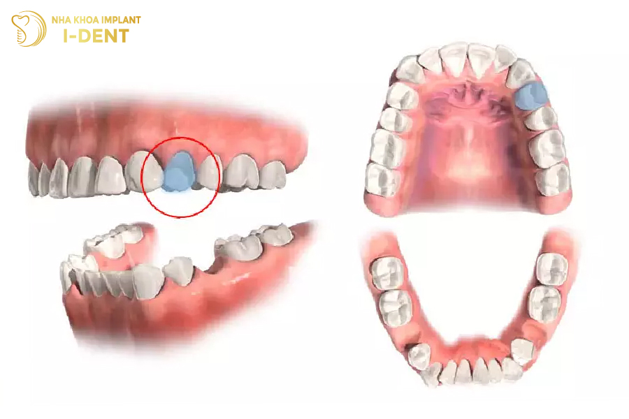 Nhổ răng để niềng răng hô hàm nhẹ 