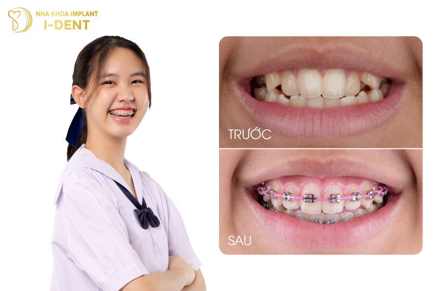 Niềng răng bằng mắc cài kim loại có hiệu quả tốt và nhanh chóng