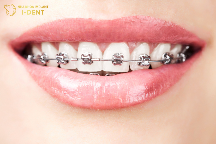 Niềng răng mắc cài kim loại