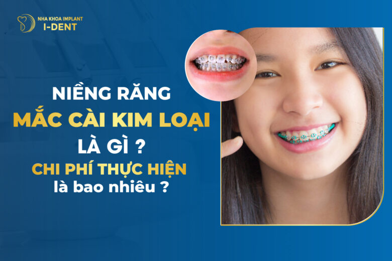 Niềng răng mắc cài kim loại giá bao nhiêu? Bảng giá 2026