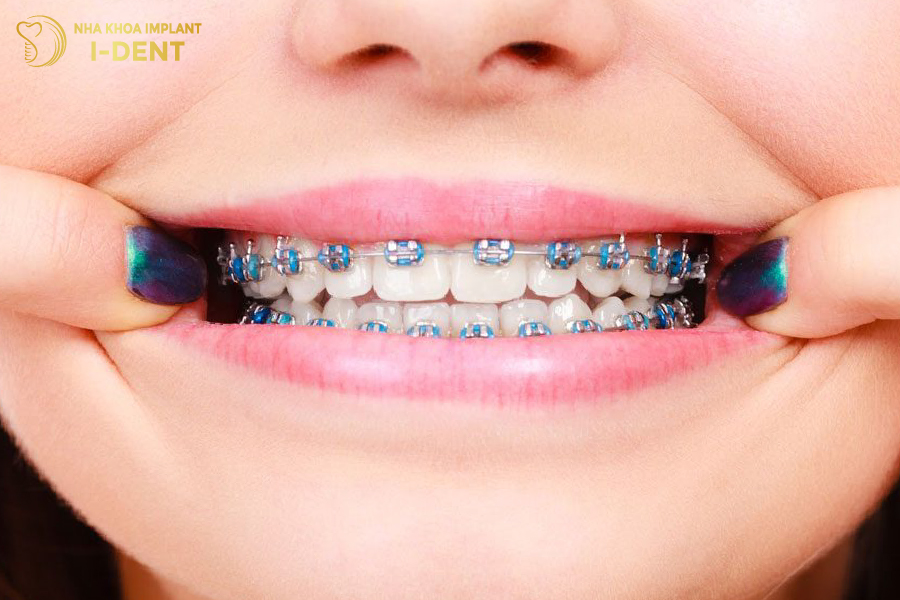 Niềng răng mắc cài kim loại tự đóng giúp rút ngắn thời gian niềng
