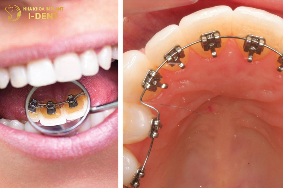Niềng răng mắc cài mặt lưỡi yêu cầu bác sĩ thực hiện có tay nghề cao