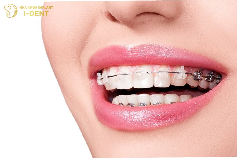 Sử dụng mắc cài sứ mang đến thẩm mỹ cao