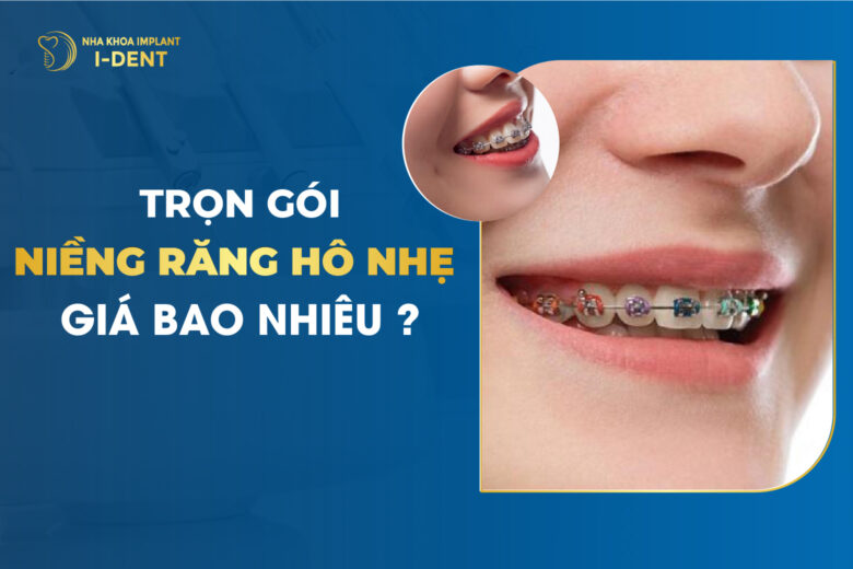 Niềng Răng Hô Bao Nhiêu? Bảng Giá 2026