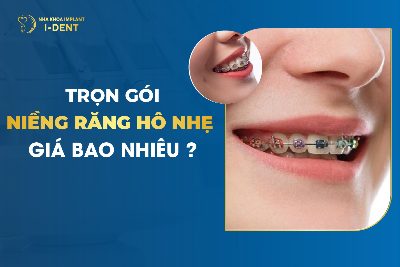 Niềng Răng Hô Bao Nhiêu? Bảng Giá 2026