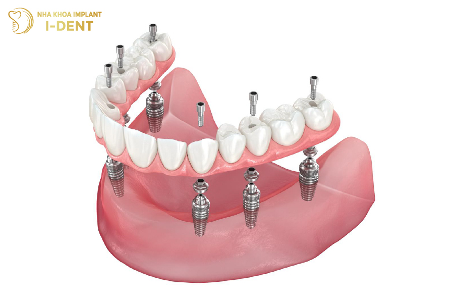 trồng răng implant all on 6
