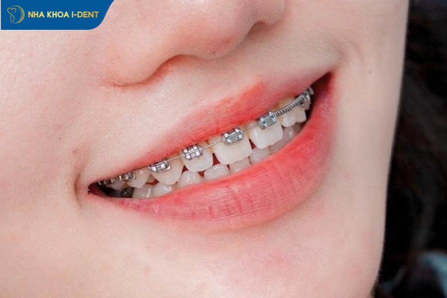 niềng răng cửa thưa mất bao nhiêu tiền