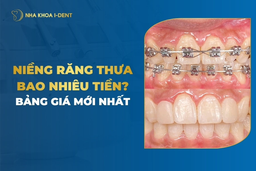 niềng răng thưa bao nhiêu tiền