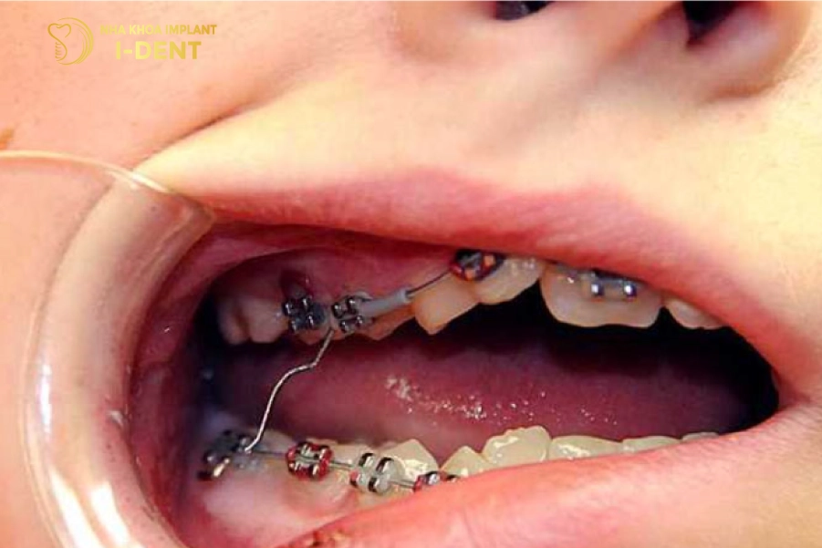 Niềng răng có thể gây tổn thương mô mềm