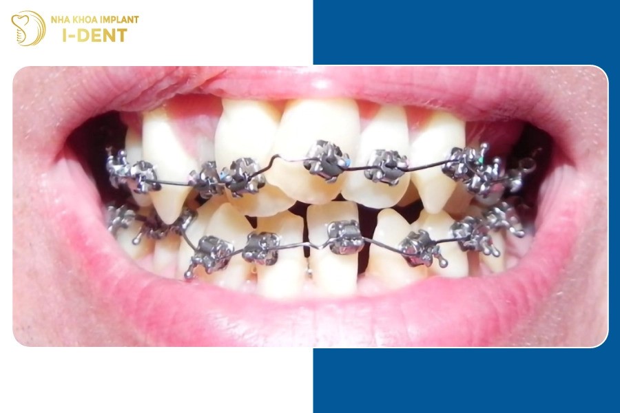 Răng có mức độ sai lệch nặng thì nên chọn niềng kim loại