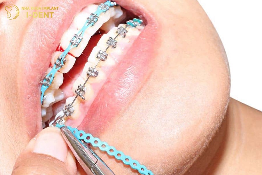 niềng răng khấp khểnh mất bao lâu