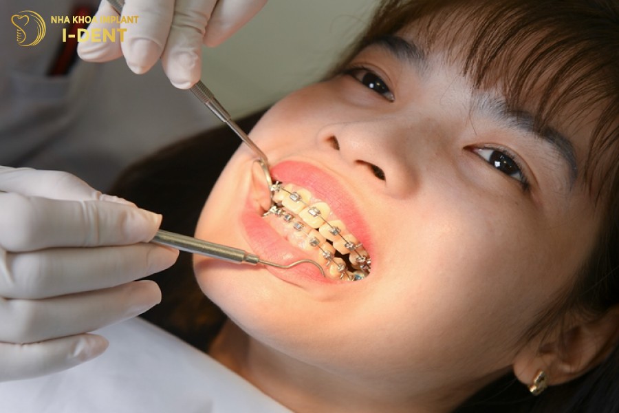 Bac-si-tien-hanh-gan-co-dinh-cac-khi-cu-chinh-nha-len-rang