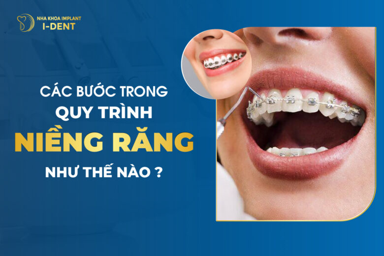 Các Bước Trong Quy Trình Niềng Răng Như Thế Nào?