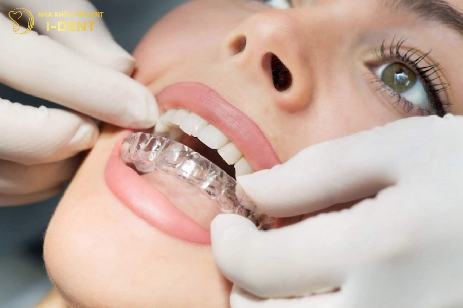 Lựa chọn gói niềng răng phụ thuộc vào tình trạng răng và ngân sách