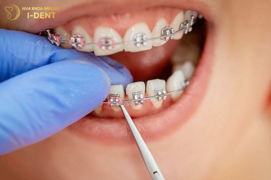 Niềng răng mắc cài kim loại thường