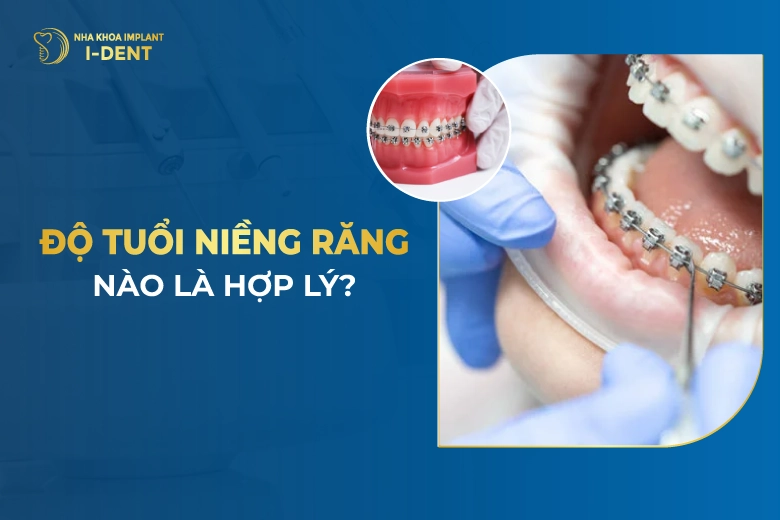 Bao Nhiêu Tuổi Niềng Răng Được? Độ Tuổi Tốt Nhất