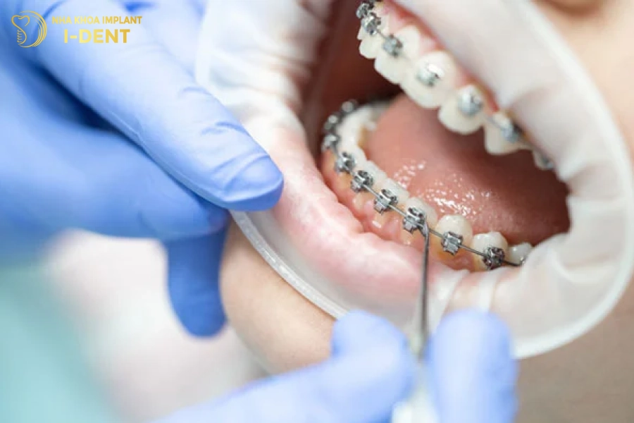 Niềng răng sớm tiết kiệm thời gian và chi phí hơn