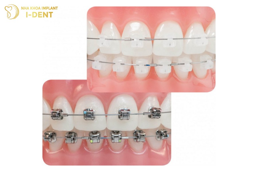 Hieu-qua-dieu-chinh-rang-khi-nieng-mac-cai-trong-suot-khong-thua-kem-mac-cai-kim-loai