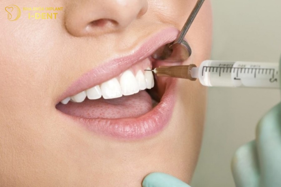 bắt cầu răng sứ