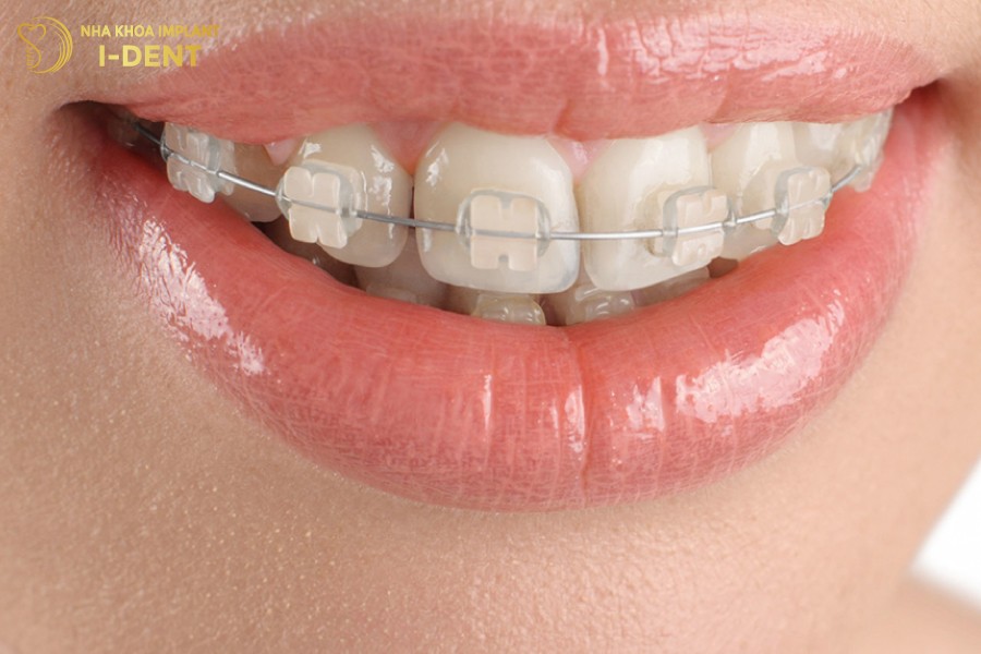 Mắc cài sứ trong suốt nên có tính thẩm mỹ cao