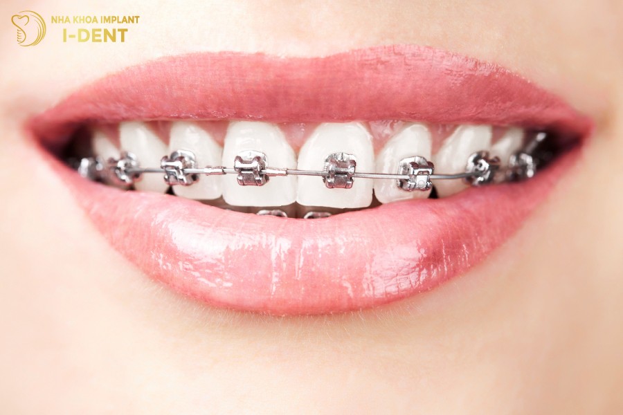 Mắc cài và dây cung được sử dụng trong tất cả phương án niềng răng mắc cài