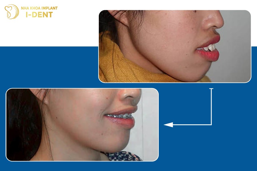 Neu-ho-do-rang-thi-phuong-phap-nieng-rang-se-mang-den-hieu-qua-toi-uu