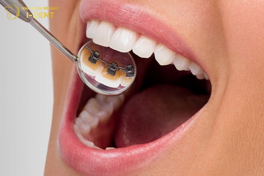 Nếu muốn đảm bảo thẩm mỹ khi niềng răng thì có thể chọn niềng mặt trong