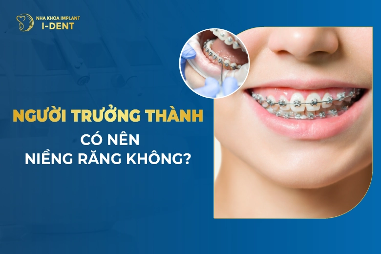 Có Nên Niềng Răng Không? Lợi Ích Và Chi Phí