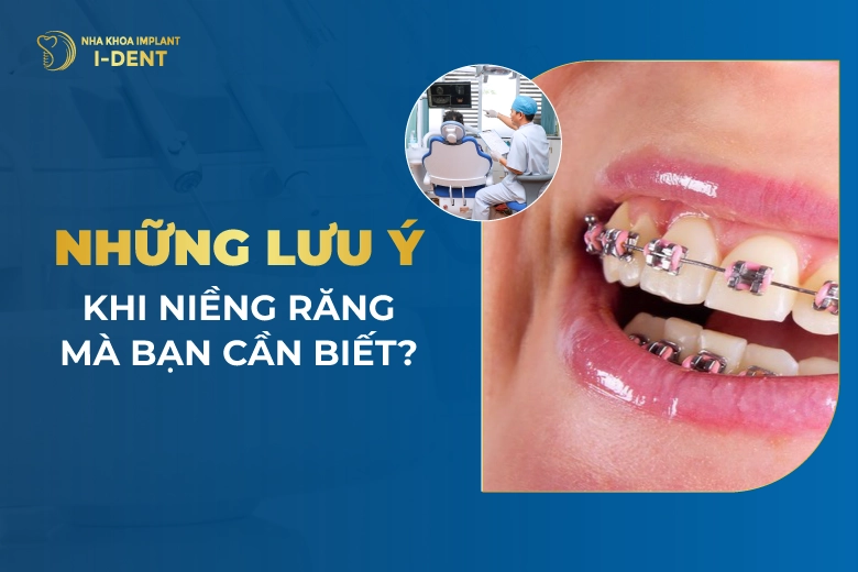 Những Lưu Ý Khi Niềng Răng Mà Bạn Cần Biết?