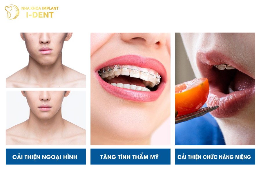 Những-ưu-điểm-của-niềng-răng